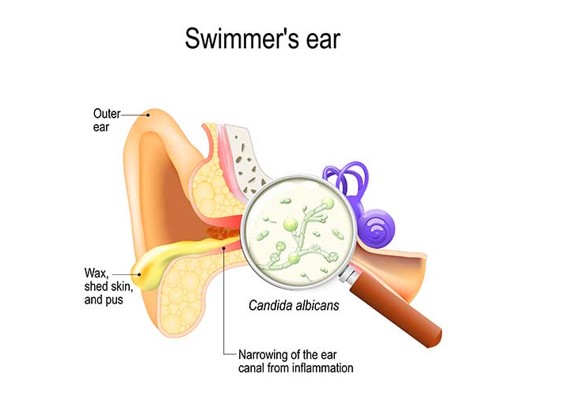 How to avoid ear infections while swimming? - DrDennisChua.com