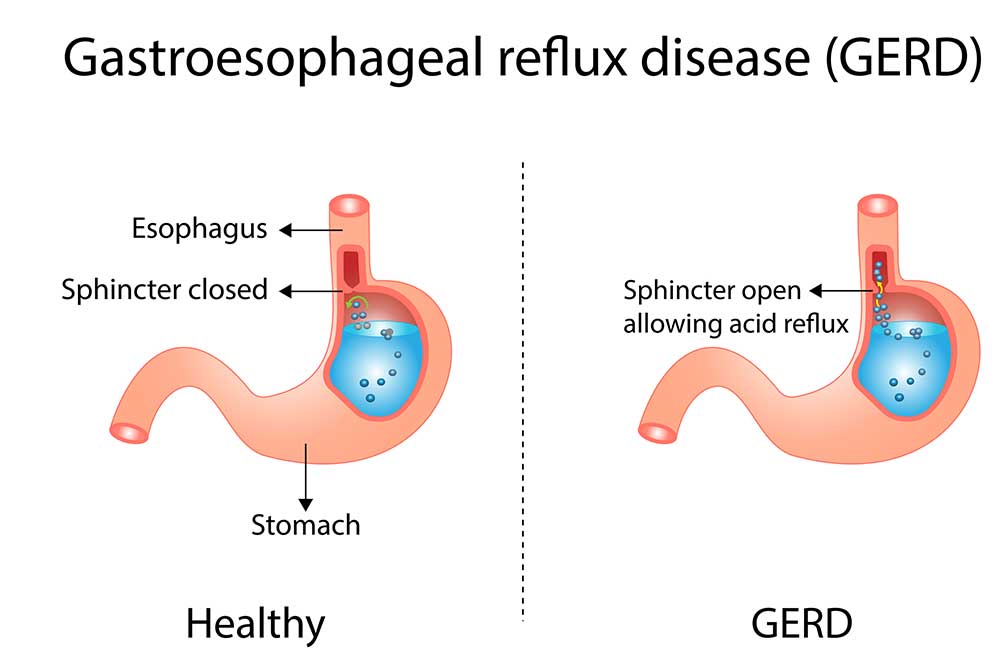 Heartburn symptons, causes, risk factors and emergency room treatment options